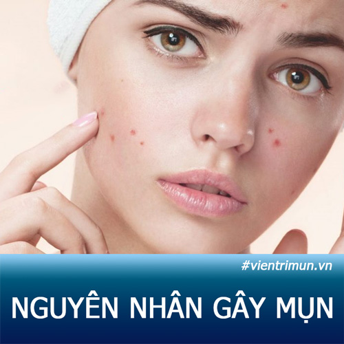 TOP 9 NGUYÊN NHÂN chính GÂY RA MỤN mà không phải ai cũng biết!