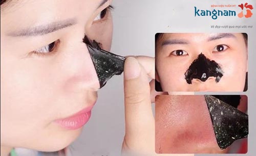 LỘT MỤN ĐẦU ĐEN có tốt không? Cách lột mụn đầu đen HIỆU QUẢ nhất