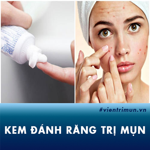 Trị mụn bằng kem đánh răng có tốt không? Chuyên gia da liễu tư vấn