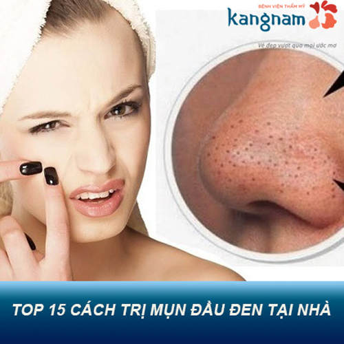 TOP 15 cách trị mụn đầu đen – Giải pháp cho làn da trắng mịn ngay tại nhà