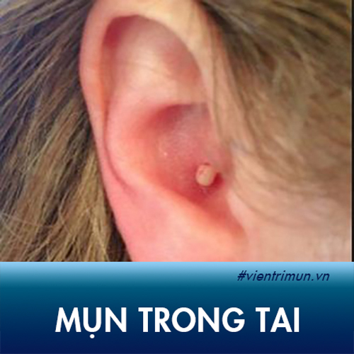 Giải đáp mọi thắc mắc về mụn trong tai: Nguyên nhân, mức độ nguy hiểm và cách chữa trị