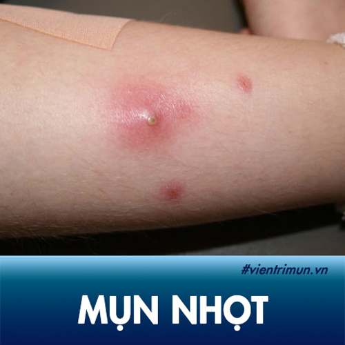 Tìm hiểu từ A – Z về Mụn Nhọt: Triệu chứng, Nguyên nhân, Cách chữa trị Tận Gốc