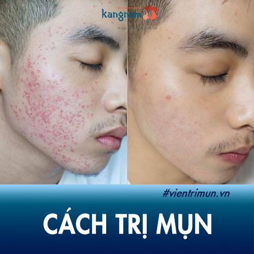 TOP 14 Cách Trị Mụn tại nhà Đơn Giản, Hiệu Quả nhất