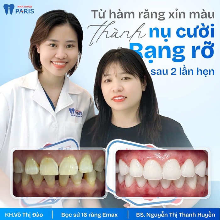 Hình ảnh khách hàng bọc răng sứ ở Paris HCM